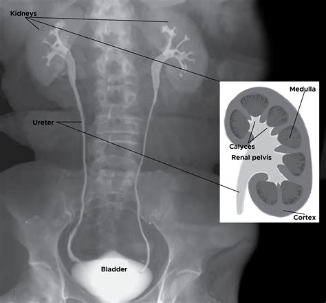 What Is a Kidney Ureter Bladder X.